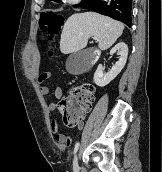 Bilateral rectus sheath hematomas (Radiopaedia 50778-56252 B 27).jpg