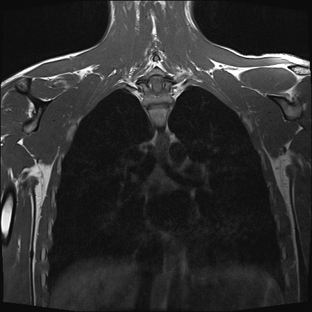 File:Bilateral spinoglenoid notch ganglion cysts (Radiopaedia 29577-30082 Coronal T1 20).jpg