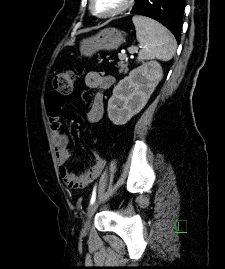 Bilateral sporadic synchronous clear cell renal cell carcinoma (Radiopaedia 85035-100575 E 40).jpg