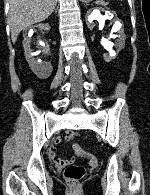 Bilateral staghorn calculi (Radiopaedia 59475-66842 Coronal non-contrast 70).jpg
