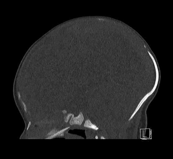 Bilateral subdural hemorrhage and parietal skull fracture (Radiopaedia 26058-26192 Sagittal bone window 49).png