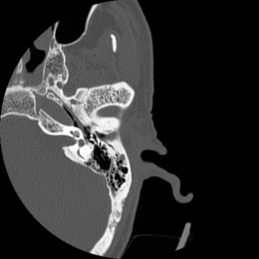Bilateral temporal bone fractures (Radiopaedia 29482-29970 D 78).jpg