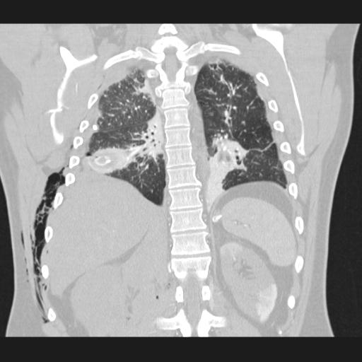 Bilateral traumatic renovascular injury (Radiopaedia 32051-32995 Coronal lung window 58).jpg