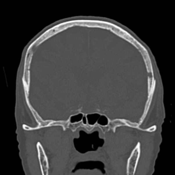 Biparietal osteodystrophy (Radiopaedia 46109-50463 Coronal bone window 46).jpg
