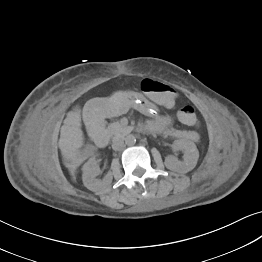 File:Bleeding duodenal ulcer (Radiopaedia 53244-59213 Axial non-contrast 14).png