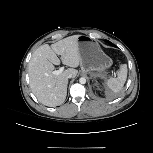 Blunt abdominal trauma with solid organ and musculoskelatal injury with active extravasation (Radiopaedia 68364-77895 A 28).jpg