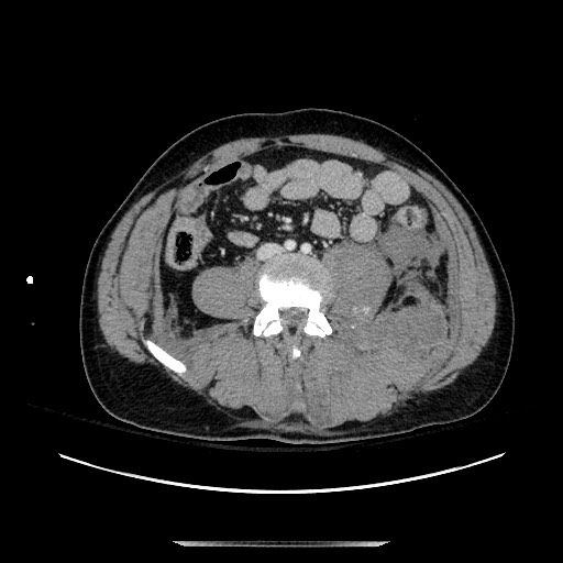 Blunt abdominal trauma with solid organ and musculoskelatal injury with active extravasation (Radiopaedia 68364-77895 A 93).jpg