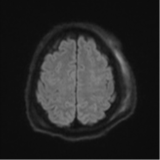 File:Blunt cerebrovascular injury (Radiopaedia 53682-59745 Axial DWI 54).png