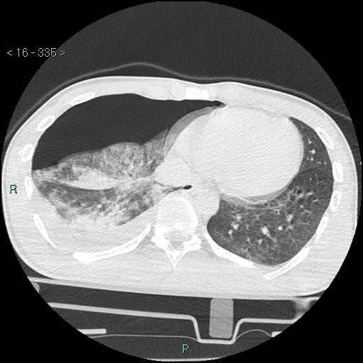 Blunt chest trauma (Swiss cheese sign) (Radiopaedia 38519-40618 Axial lung window 56).jpg