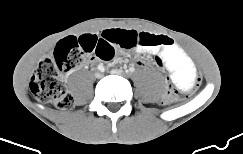 Blunt injury to the small bowel (Radiopaedia 74953-85987 A 119).jpg
