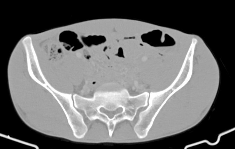 Blunt injury to the small bowel (Radiopaedia 74953-85987 Axial Wide 74).jpg