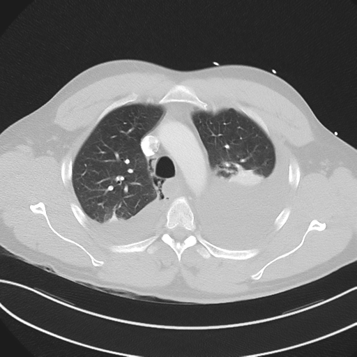 File:Boerhaave syndrome (Radiopaedia 39382-41660 Axial lung window 16).png