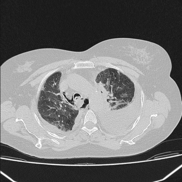 Boerhaave syndrome (Radiopaedia 45644-49799 Axial lung window 46).jpg
