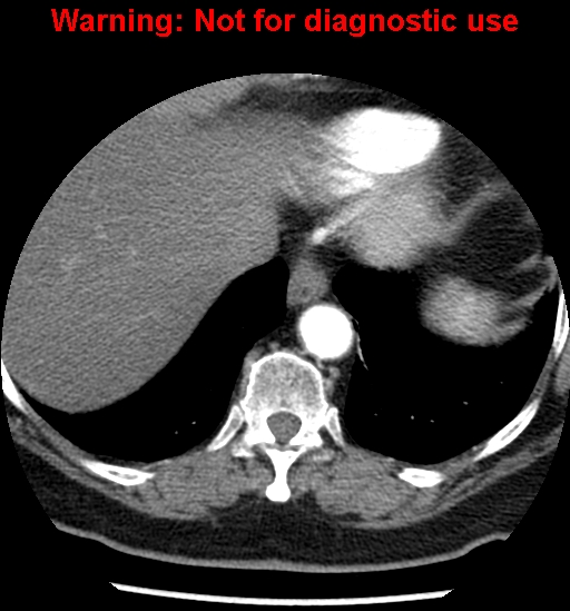File:Bosniak renal cyst - type II (Radiopaedia 23404-23468 B 5).jpg