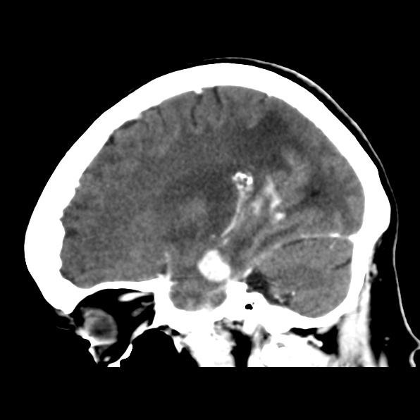 File:Brain metastases from breast cancer (Radiopaedia 23178-23231 C 17).jpg