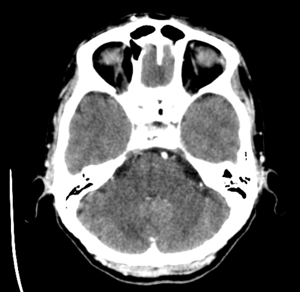 File:Brain metastases from lung cancer (Radiopaedia 24480-24781 Axial C+ delayed 13).jpg