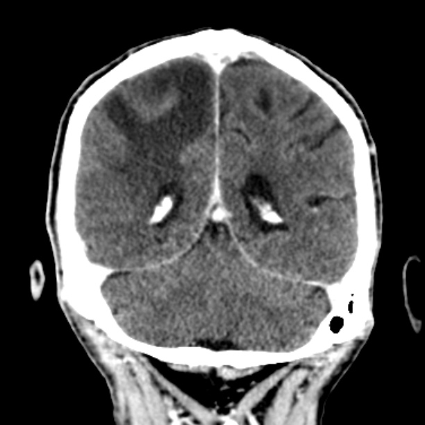 Brain metastases from lung cancer (Radiopaedia 27849-28092 Coronal C+ delayed 48).jpg