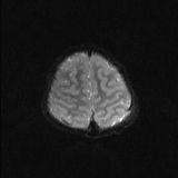Brainstem glioma (Radiopaedia 67531-76922 Axial DWI 20).jpg