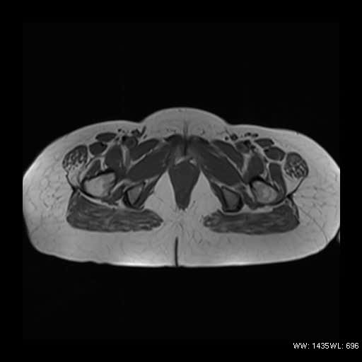 File:Broad ligament fibroid (Radiopaedia 49135-54241 Axial T1 15).jpg