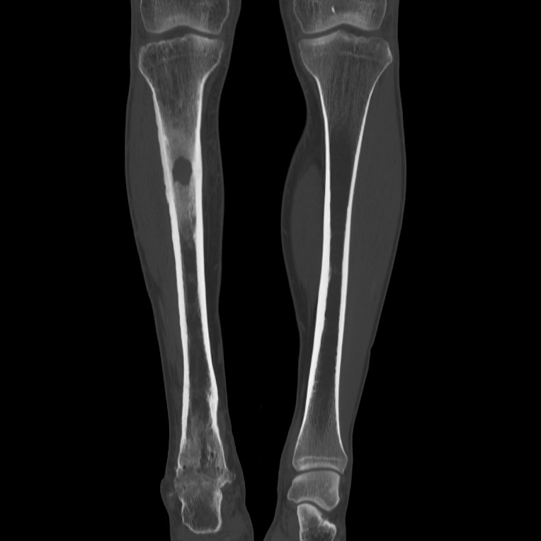 Brodie abscess - tibia (Radiopaedia 66028-75204 Coronal bone window 22).jpg