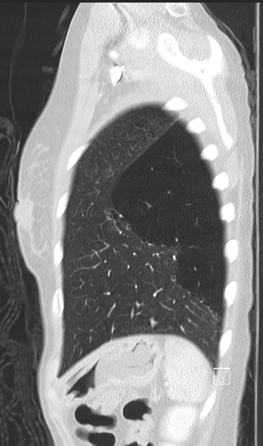 Bronchial atresia (Radiopaedia 73677-84470 Sagittal lung window 47).jpg