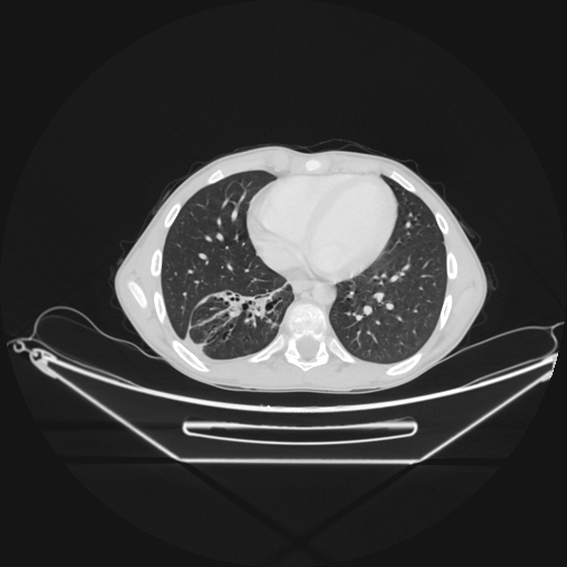 Bronchial carcinoid tumor (Radiopaedia 57187-64090 Axial lung window 57).jpg