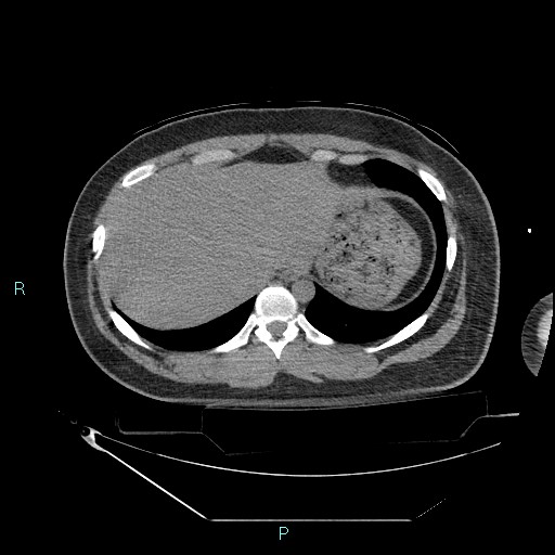 Bronchial carcinoid tumor (Radiopaedia 78272-90870 Axial non-contrast 91).jpg