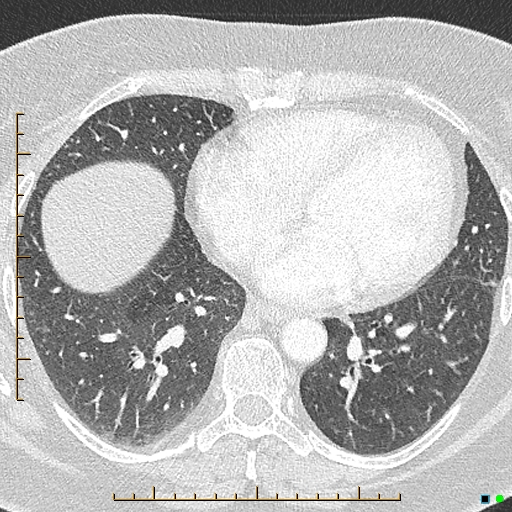 File:Bronchial diverticula (Radiopaedia 79512-92676 Axial lung window 135).jpg