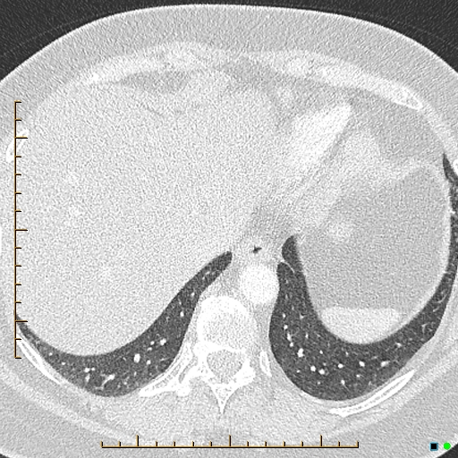 Bronchial diverticula (Radiopaedia 79512-92676 Axial lung window 175).jpg
