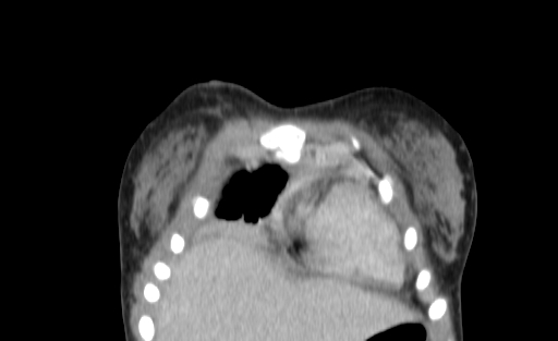 Bronchial mucoepidermoid carcinoma (Radiopaedia 57023-63895 Coronal 4).jpg