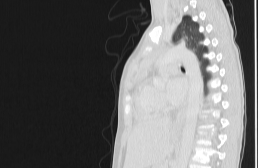 Bronchial mucoepidermoid carcinoma (Radiopaedia 57023-63895 Sagittal lung window 102).jpg