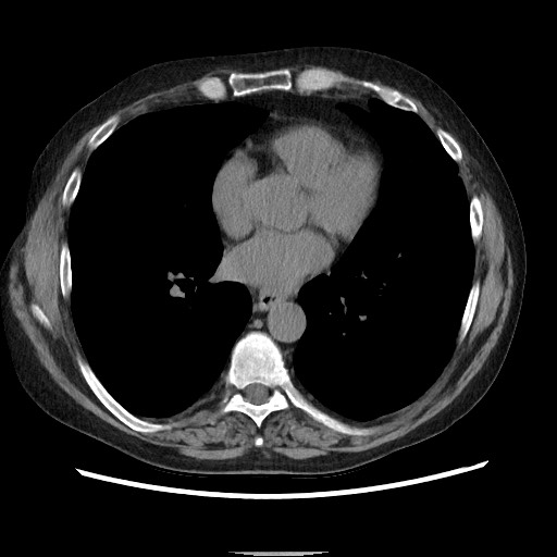 File:Bronchial stenosis - lung transplant (Radiopaedia 73133-83848 Axial non-contrast 38).jpg