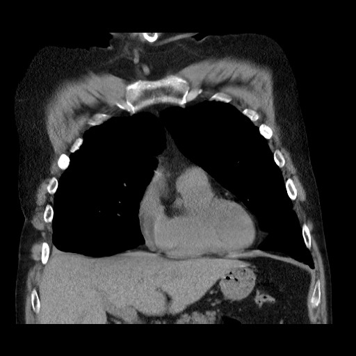 Bronchial stenosis - lung transplant (Radiopaedia 73133-83848 Coronal non-contrast 24).jpg