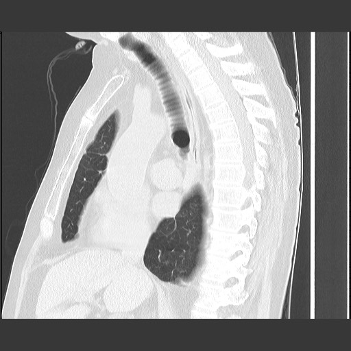 Bronchial stenosis - lung transplant (Radiopaedia 73133-83848 Sagittal lung window 34).jpg