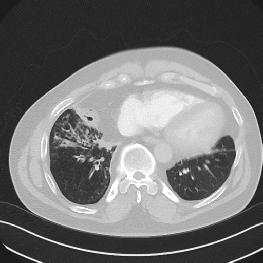 Bronchiectasis (Radiopaedia 39385-41666 Axial lung window 47).png