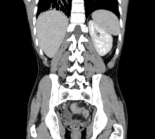 Bronchiectasis in Crohn disease (Radiopaedia 60311-67977 C 63).jpg
