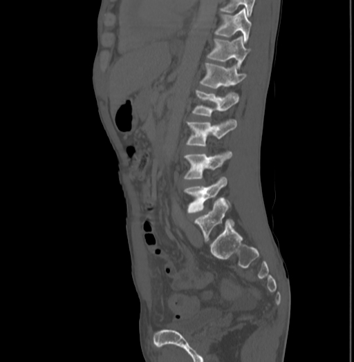Bronchiectasis in Crohn disease (Radiopaedia 60311-67977 Sagittal bone window 148).jpg