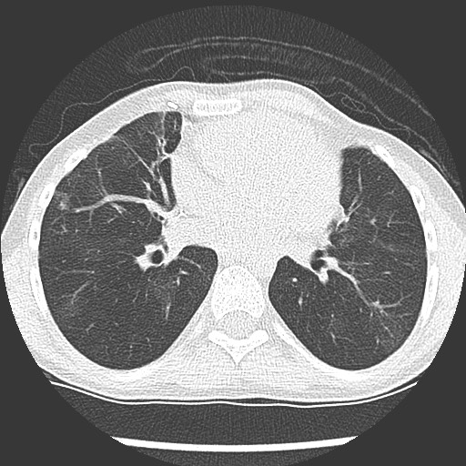 Bronchiolotis obliterans (Radiopaedia 73769-84575 Axial lung window 27).jpg