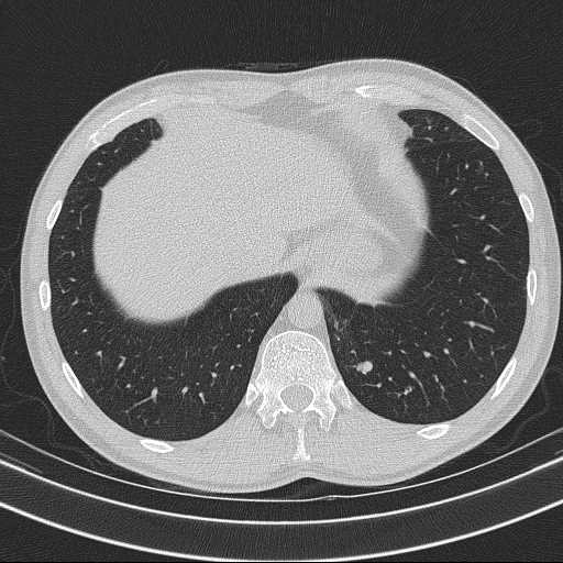 Bronchocele (Radiopaedia 60676-68429 Axial lung window 62).jpg