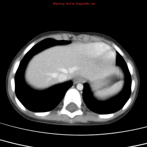 File:Bronchogenic cyst (Radiopaedia 9372-10063 C 21).jpg