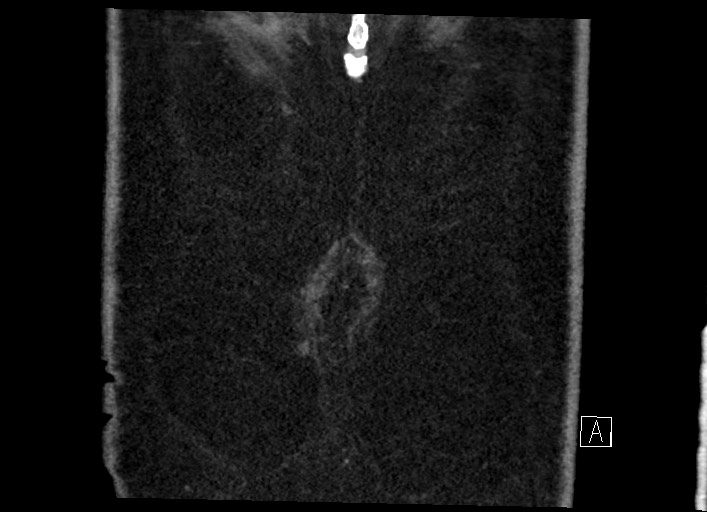 File:Buried bumper syndrome - gastrostomy tube (Radiopaedia 63843-72577 Coronal Inject 140).jpg