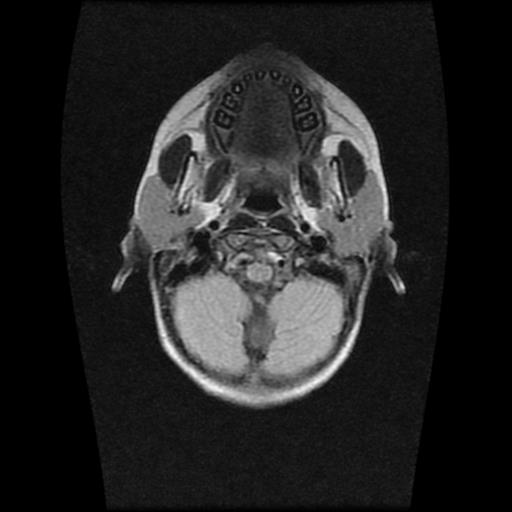 File:Burkitt lymphoma of the orbit- pre and post chemotherapy (Radiopaedia 31214-31930 Axial FLAIR 2).jpg