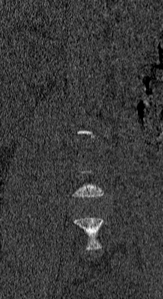 Burst fracture (Radiopaedia 53373-59357 Coronal bone window 4).jpg
