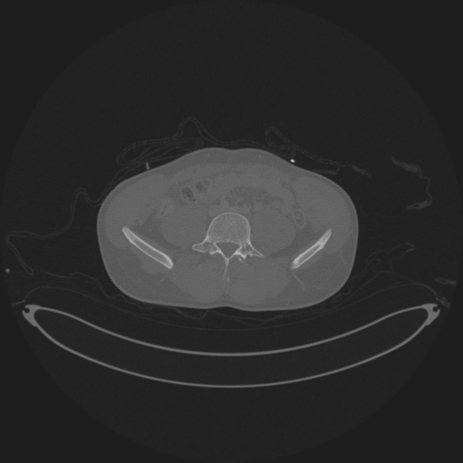 Burst fracture - T12 with conus compression (Radiopaedia 56825-63647 Sagittal bone window 1).png