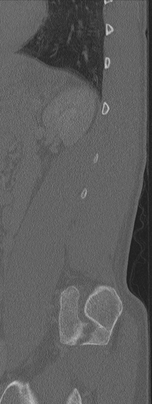 Burst fracture - T12 with conus compression (Radiopaedia 56825-63647 Sagittal bone window 14).png