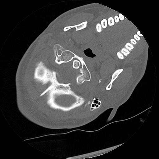 C1-C2 "subluxation" - normal cervical anatomy at maximum head rotation (Radiopaedia 42483-45607 Axial non-contrast 54).jpg
