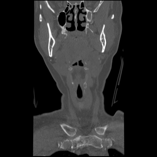 C1 anterior arch (plough) fracture - type 1 (Radiopaedia 76181-87720 Coronal bone window 85).jpg