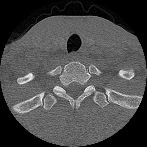 File:C5 facet fracture (Radiopaedia 58374-65499 Axial bone window 84).jpg