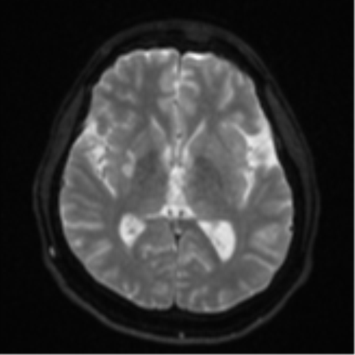 File:CNS vasculitis (Radiopaedia 55715-62263 Axial DWI 15).png