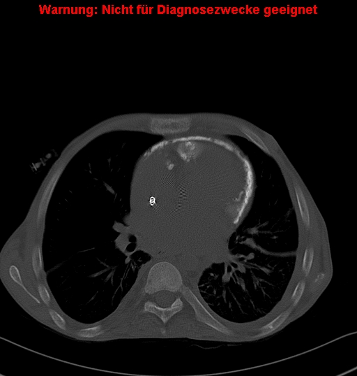 File:Calcific constrictive pericarditis (Radiopaedia 24701-24967 Axial bone window 13).jpg